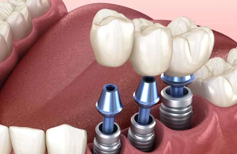 Titanium Dental Implants: A Comprehensive Guide to Modern Tooth Replacement Titanium Dental Implants