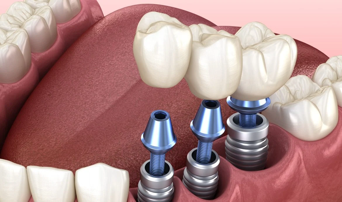 Titanium Dental Implants: A Comprehensive Guide to Modern Tooth Replacement Titanium Dental Implants