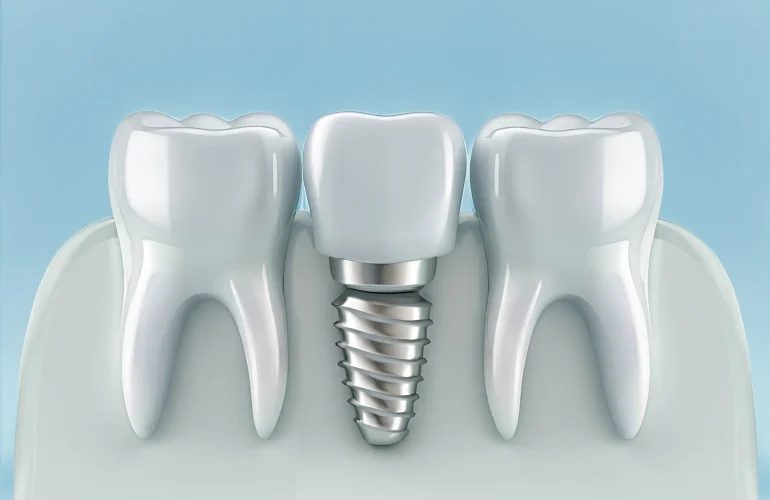 Top 7 Essential Preparations Before Your Dental Implant Treatment Top 7 Essential Preparations Before Your Dental Implant Treatment