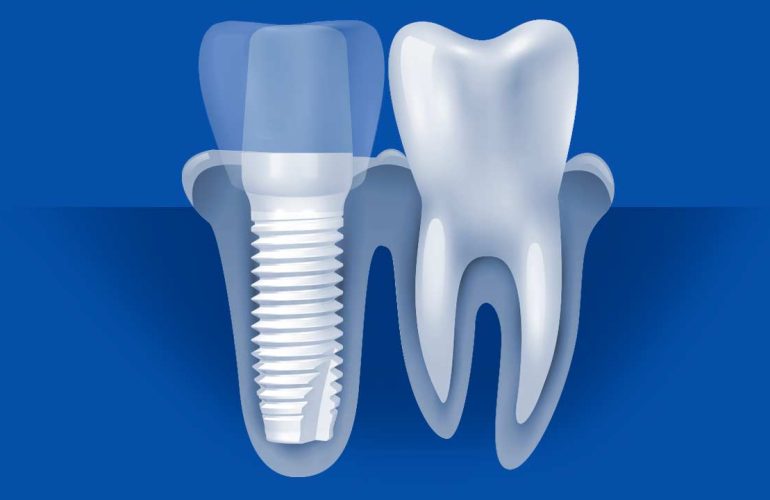What Are Zirconia Implants and How Are They Made? What Are Zirconia Implants and How Are They Made