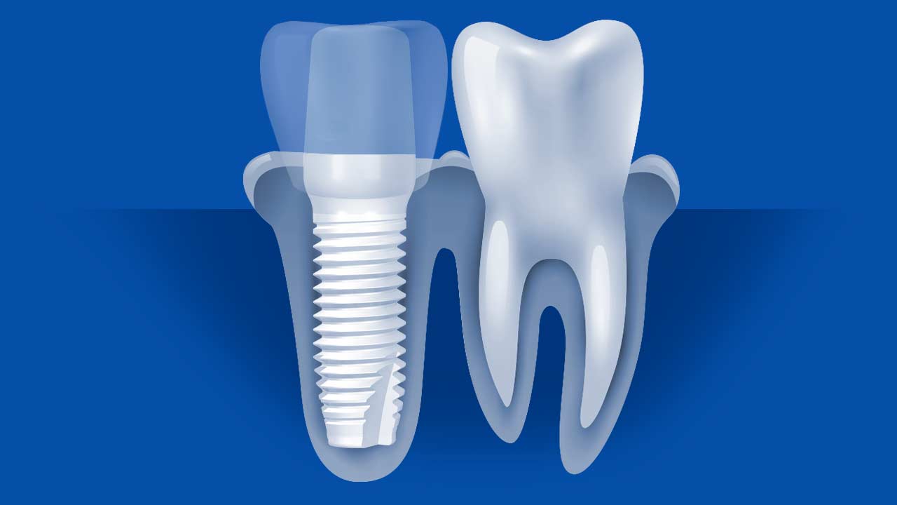 What Are Zirconia Implants and How Are They Made
