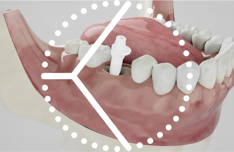 What is a Ceramic Implant? How is it Done? Who is Suitable for It? What is a Ceramic Implant