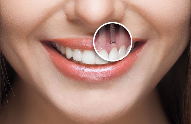 What to Do After Implant Placement