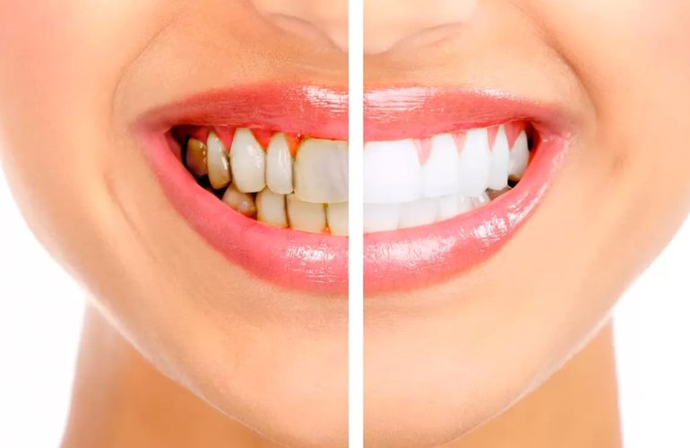 Diş Taşı Temizliği Nasıl Yapılır? diş taşı temizliği nasıl yapılır