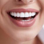 Ankara Laminate Veneers