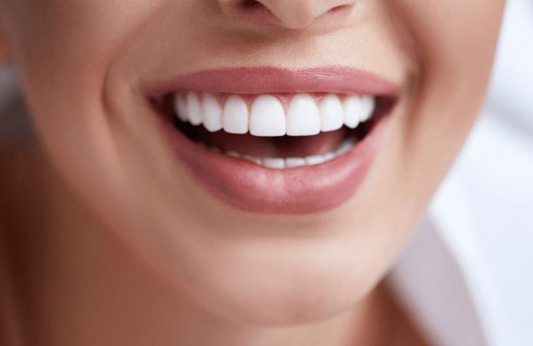 Ankara Laminate Veneers: Comprehensive Guide to Smile Transformation Ankara Laminate Veneers