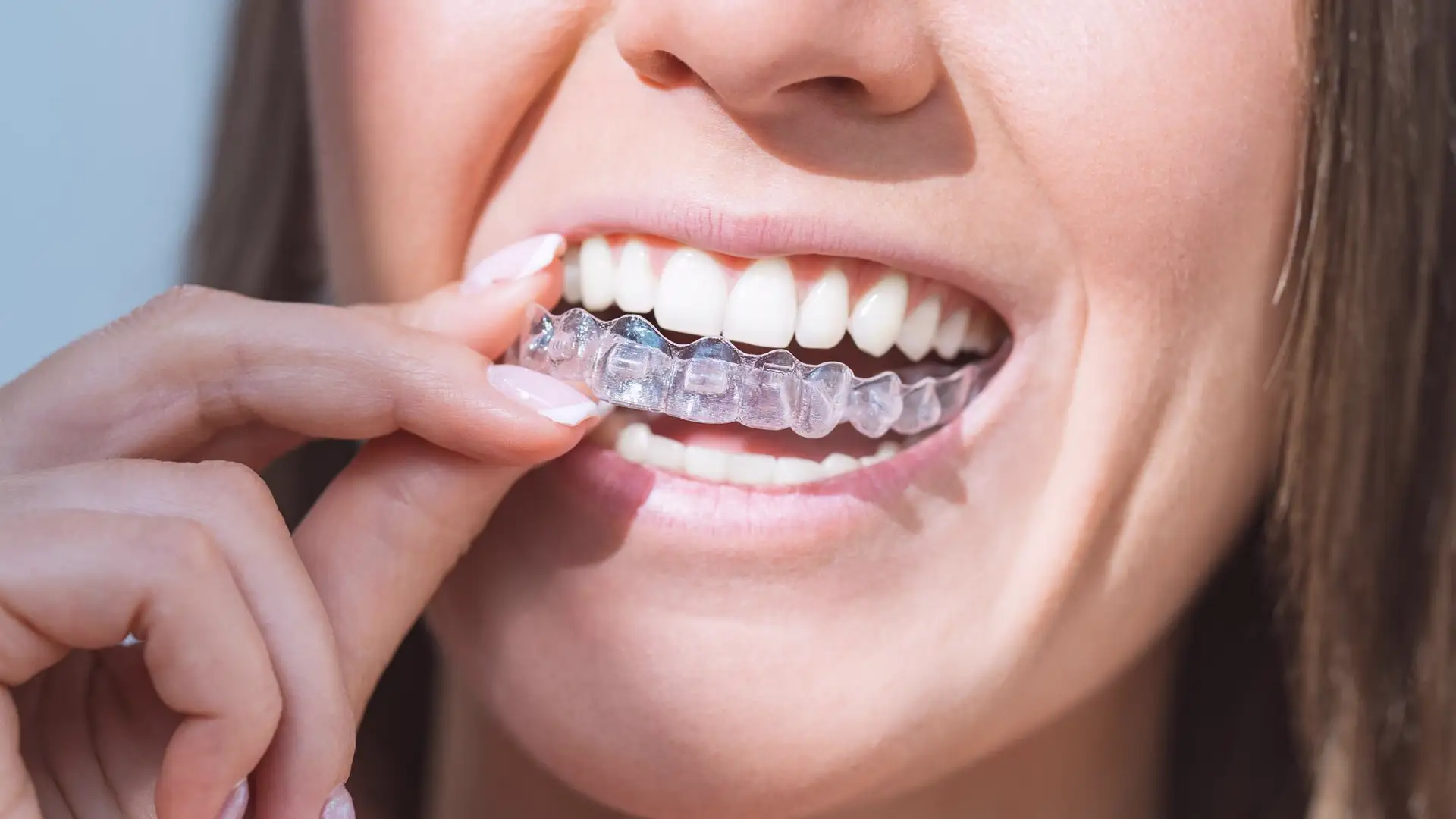 Ankara Orthodontic Treatment: Comprehensive Guide to Modern Smile Correction Ankara Orthodontic Treatment