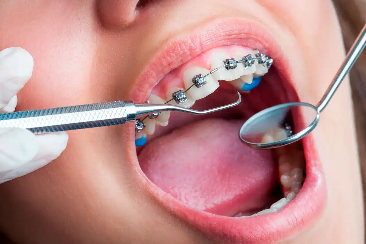 Braces Treatment in Ankara
