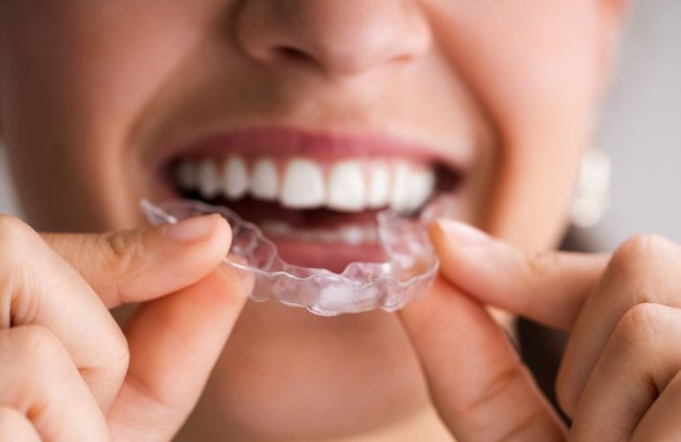 Clear Aligners Invisalign Ankara: A Comprehensive Guide to Invisible Orthodontic Treatment Clear Aligners ankara