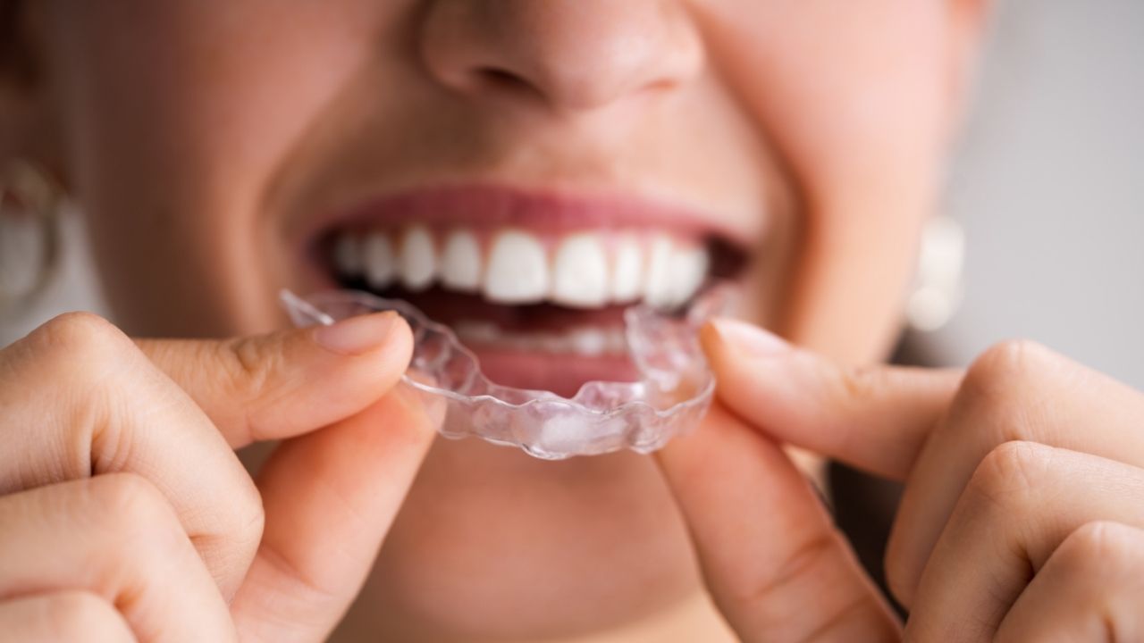 Clear Aligners Invisalign Ankara: A Comprehensive Guide to Invisible Orthodontic Treatment Clear Aligners ankara