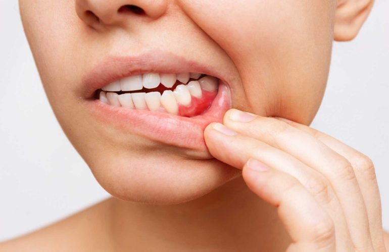 Gum Problems: Causes, Symptoms, Treatment, and Prevention Gum Problems