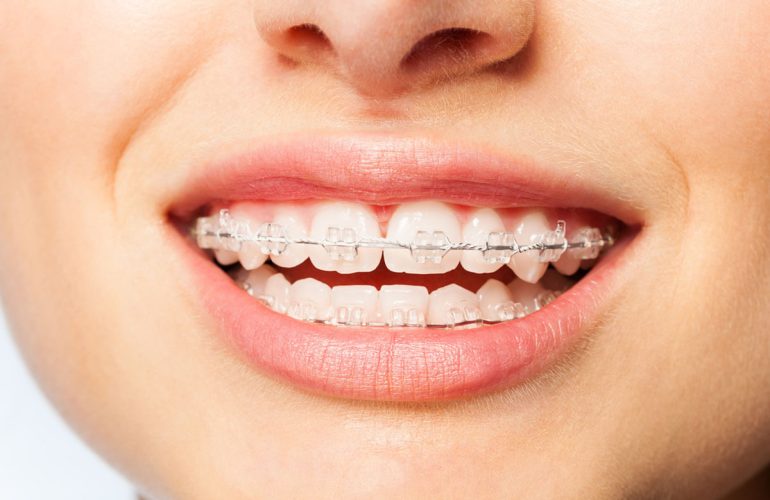 Lingual Braces (Invisible Braces) Ankara: The Ultimate Guide to Hidden Orthodontics Lingual Braces ankara