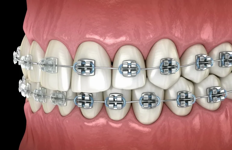 Metal Braces: The Complete Guide to Traditional Orthodontic Treatment Metal Braces
