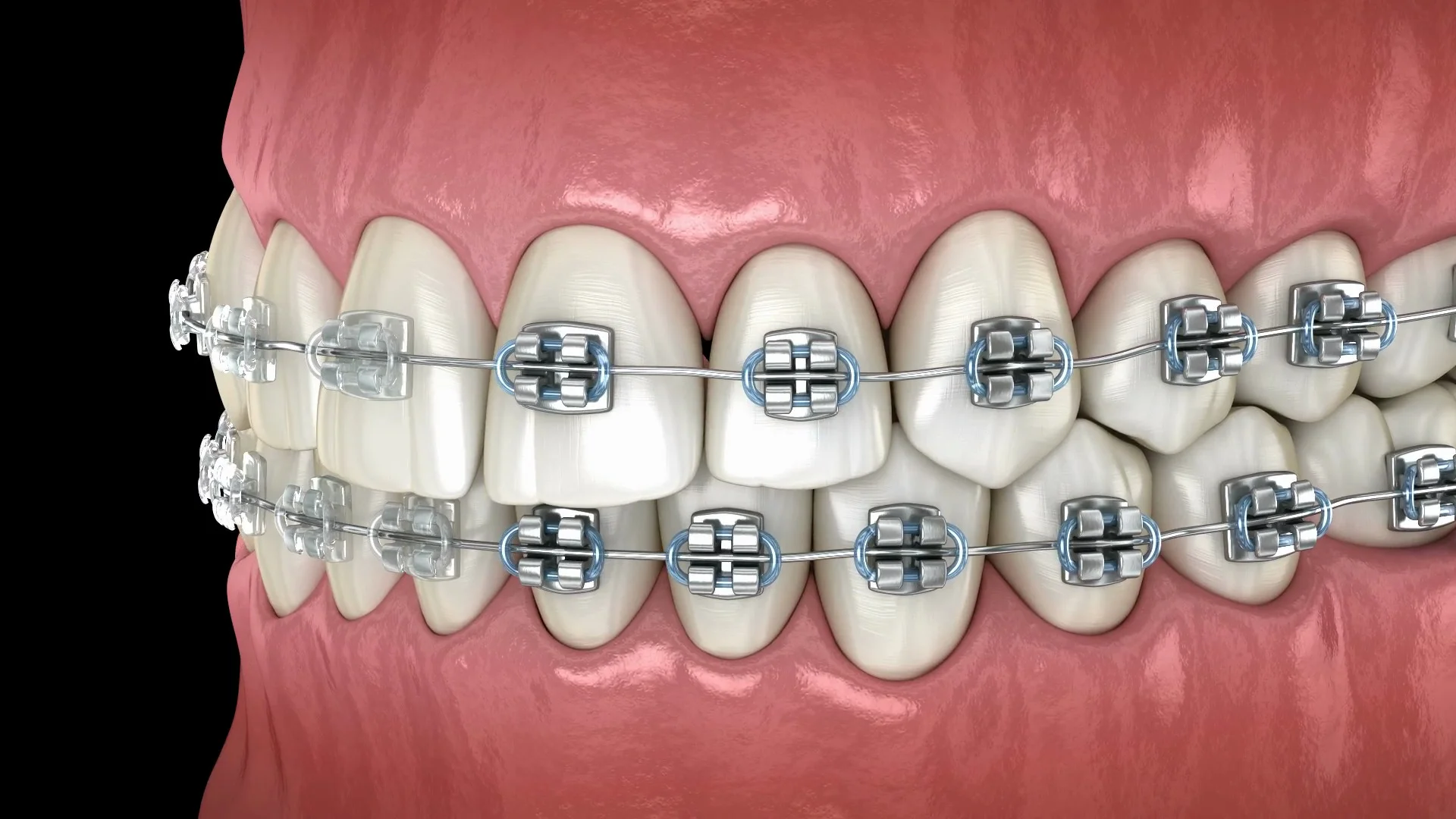 Metal Braces