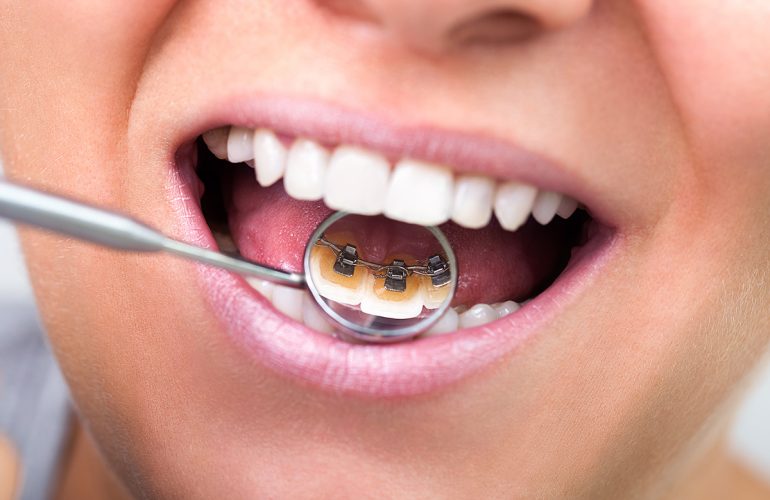 What Are the Advantages of Lingual Braces? What Are the Advantages of Lingual Braces