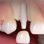 Zirconium treatment