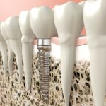 osseointegration dental implant