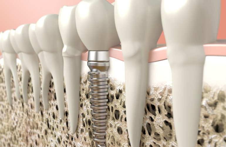 osseointegration dental implant