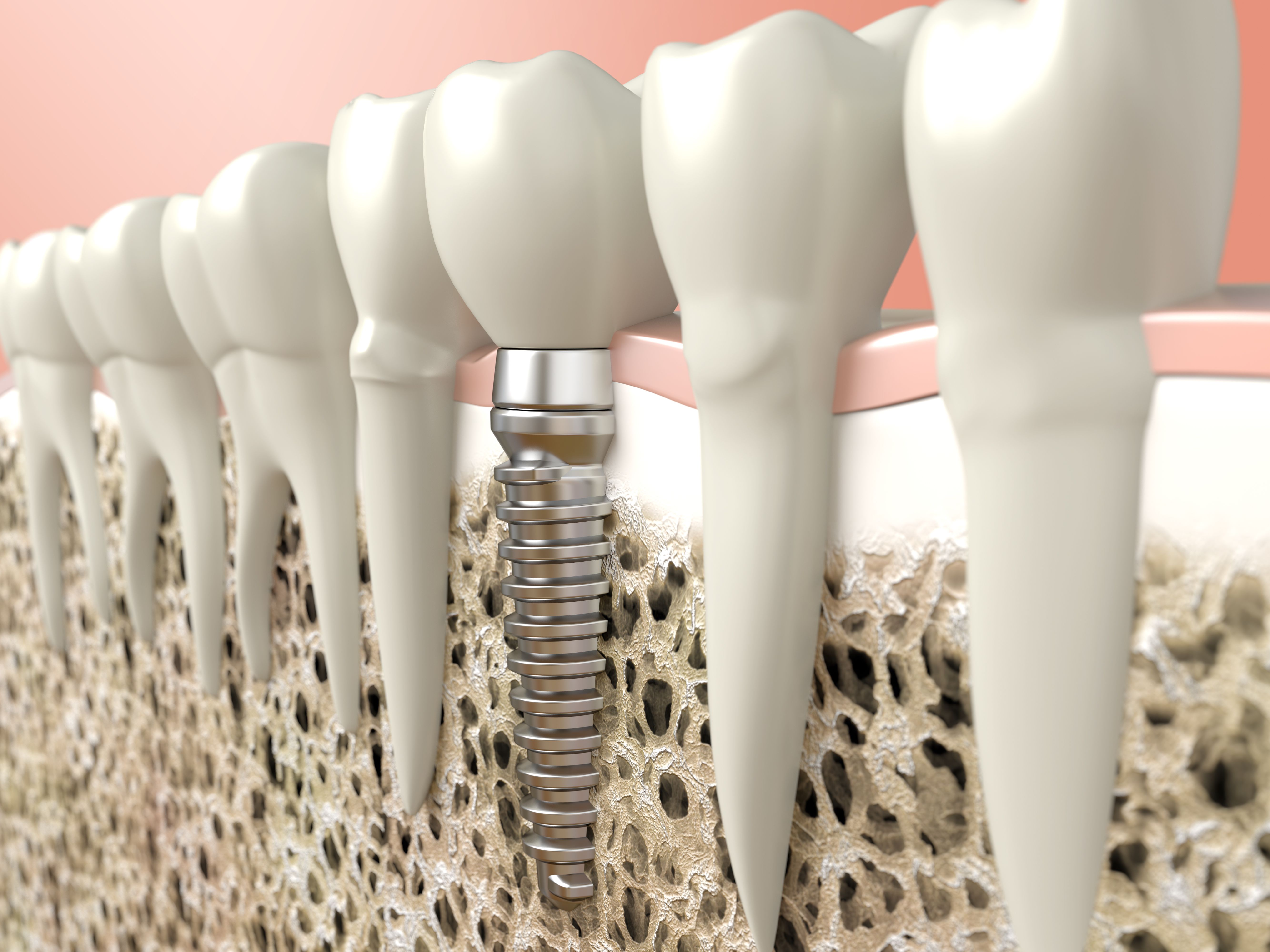 osseointegration dental implant