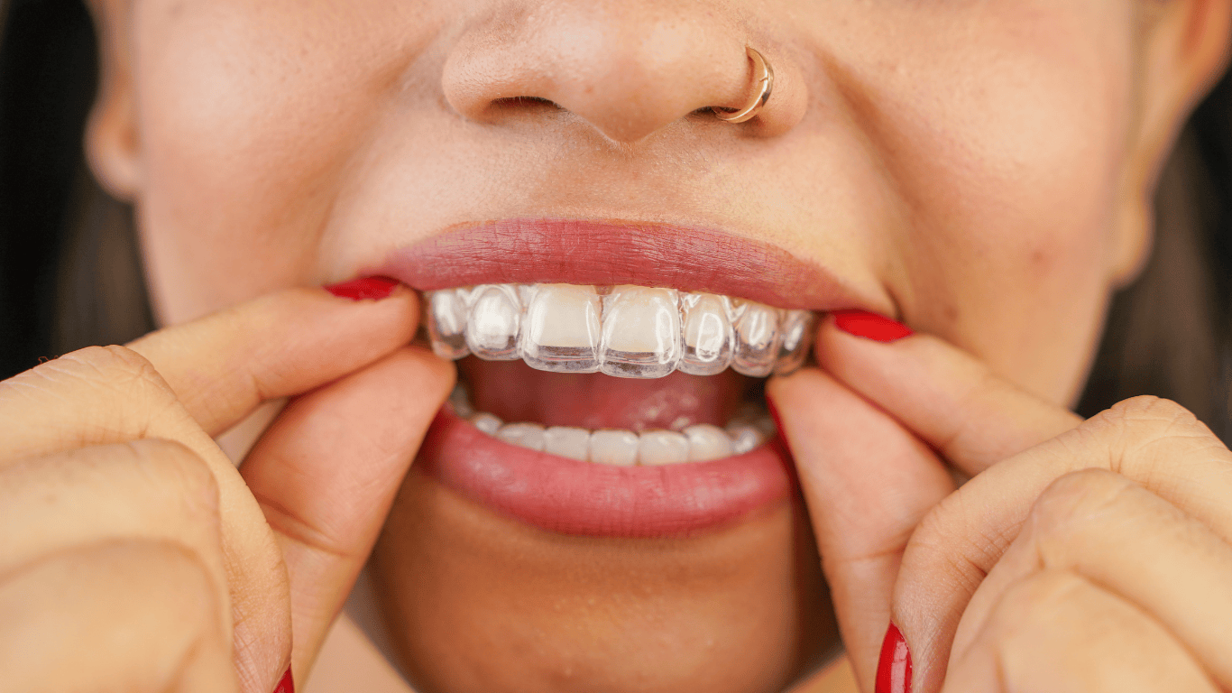 What Is a Clear Aligner and How Is It Made