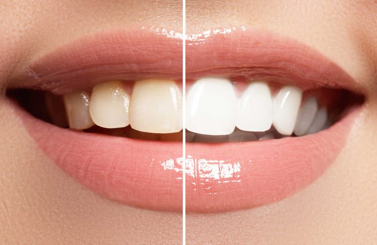 Things to Consider After Teeth Whitening