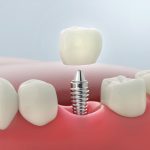 Ayni Gun Implant Tedavisi