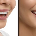 Disler Arasi Bosluk Tedavisi 1