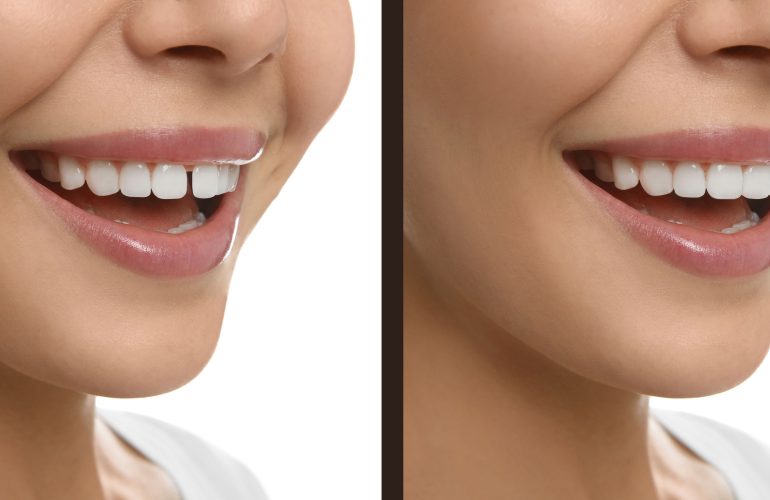 Disler Arasi Bosluk Tedavisi 1