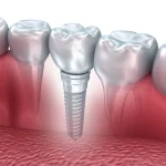 Implant Tedavi Sureci