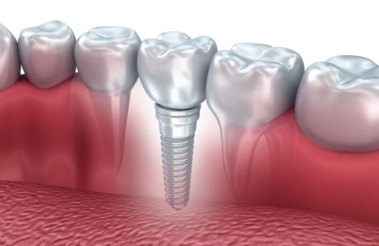 Implant Tedavi Sureci