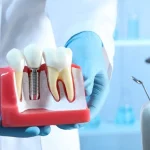 Implant Turleri ve Materyalleri