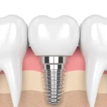 Implant Vidasi Takildiktan Sonra Dis