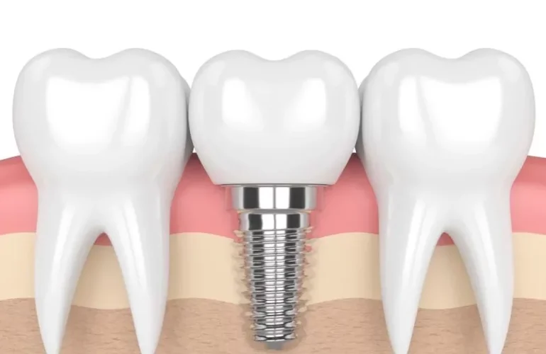 Implant Vidasi Takildiktan Sonra Dis