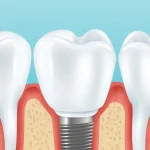 Tek Dis Implant