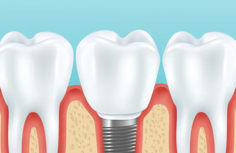 Tek Diş İmplant Fiyatı 2026 Tek Dis Implant
