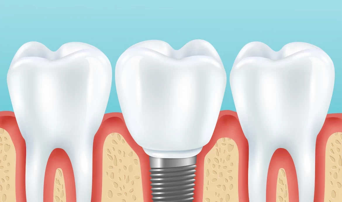 Tek Diş İmplant Fiyatı 2026 Tek Dis Implant
