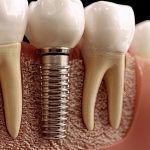 alman implant fiyatlari​