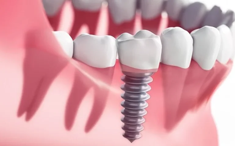 İmplant Ömrü Ne Kadardır? Diş İmplantı Kaç Yıl Dayanır? implant omru
