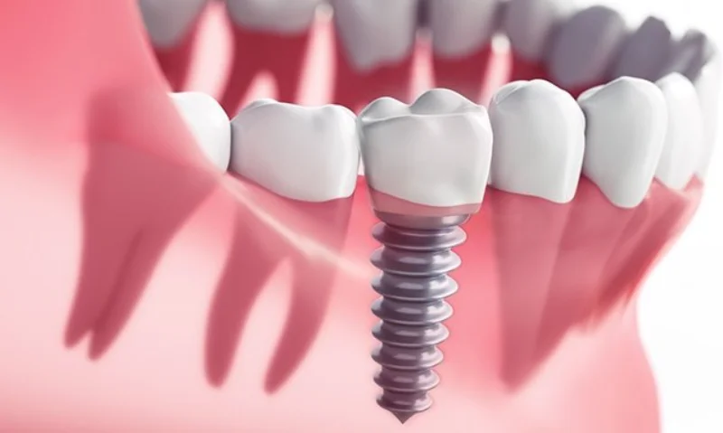 İmplant Ömrü Ne Kadardır? Diş İmplantı Kaç Yıl Dayanır? implant omru