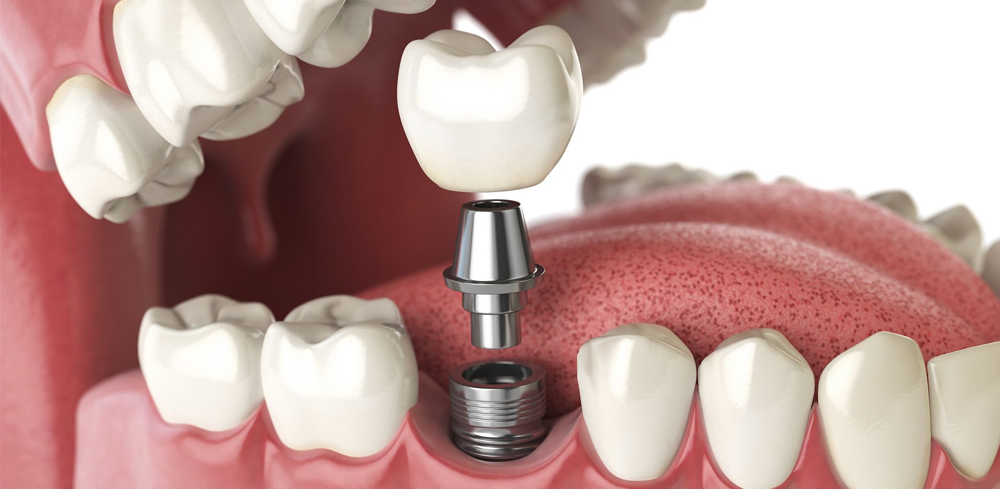 Ankara diş implantı tedavisi süreci ve biyomekanik yapısı - Simyadent