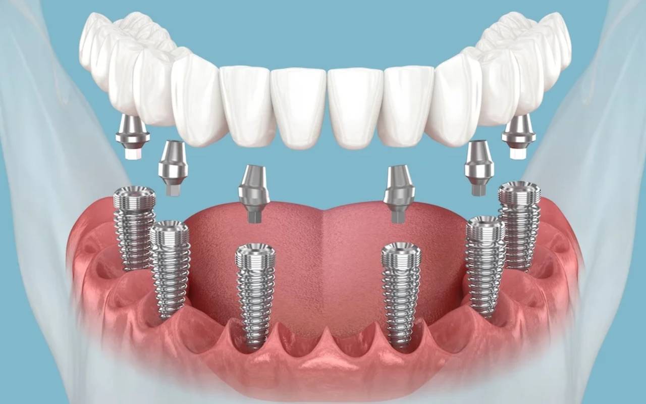 All-on-4 mü All-on-6 mı? Tam Çene İmplant Tedavilerinin Karşılaştırması All on 4 mu All on 6 mi