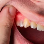 Implant Iltihabi