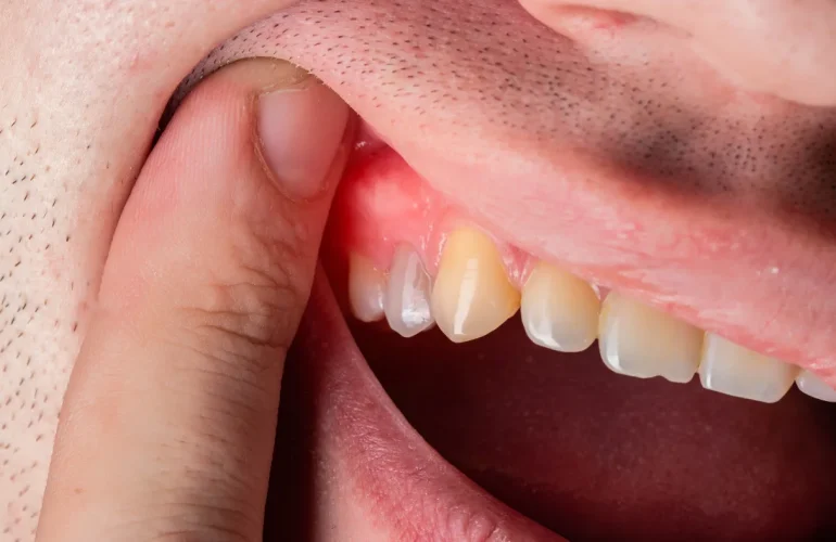 İmplant İltihabı Nedir? Belirtileri, Nedenleri ve Tedavisi Implant Iltihabi
