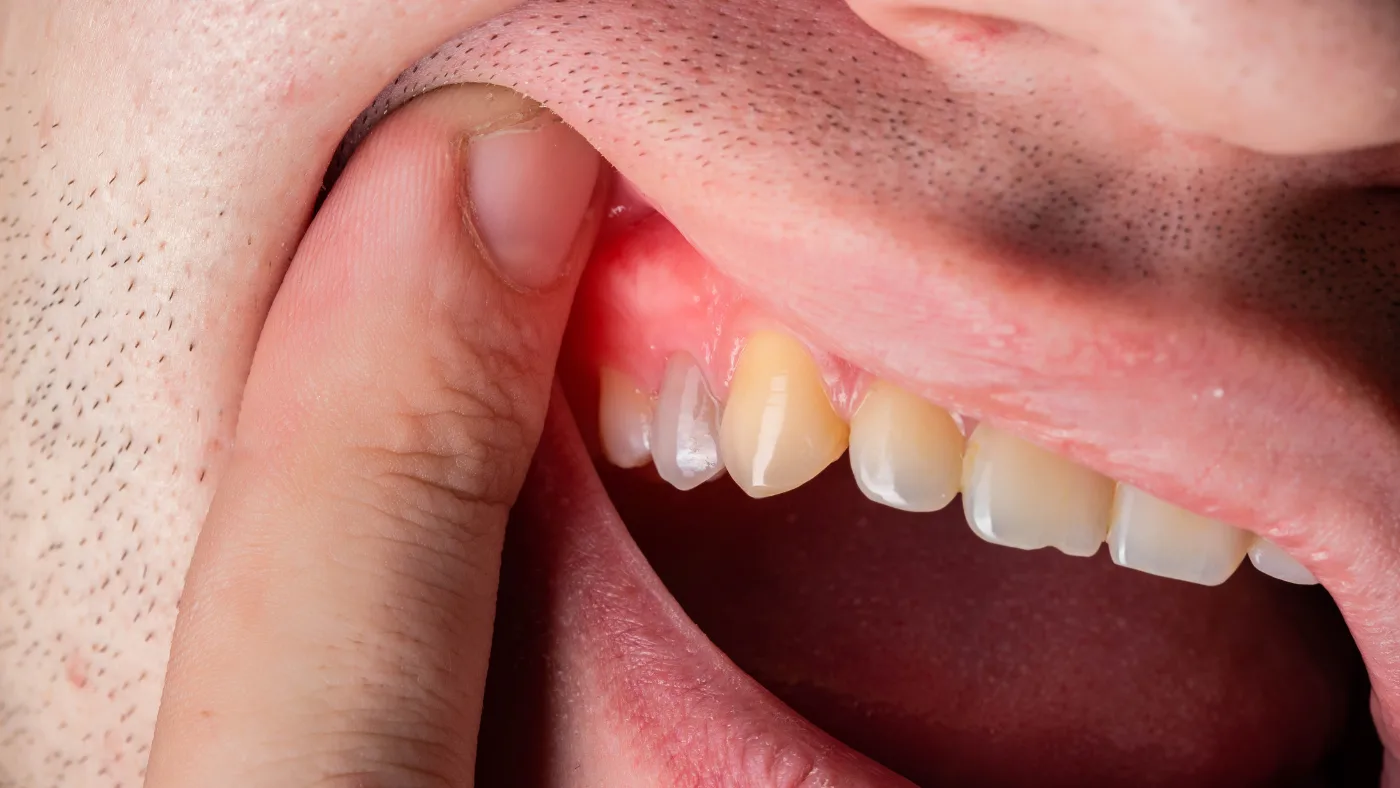 İmplant İltihabı Nedir? Belirtileri, Nedenleri ve Tedavisi Implant Iltihabi
