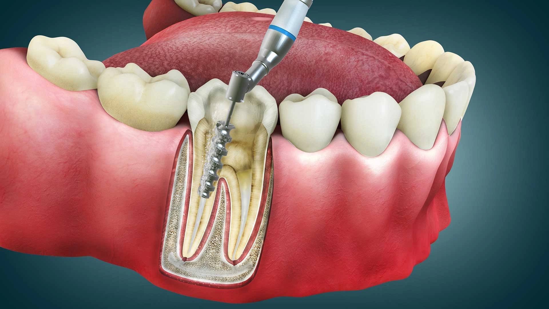 Implant Tutmazsa Ne Olur