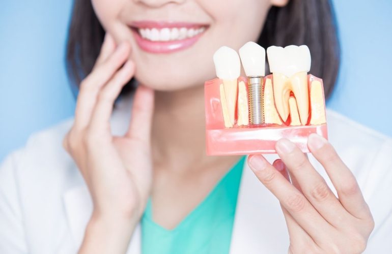 Implant Ustu Kaplama Dusmesi