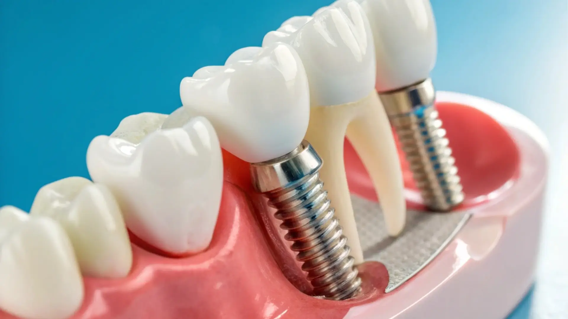 İmplant Vidası Gevşemesi Nedir? Belirtileri ve Tedavisi Implant Vidasi Gevsemesi