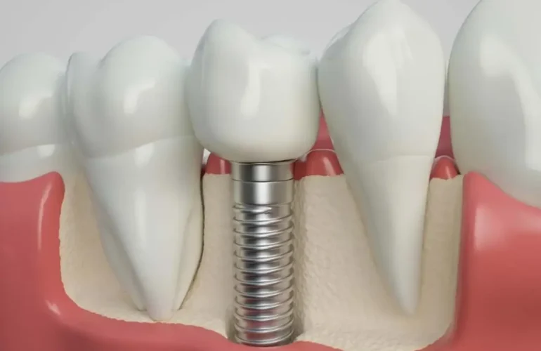İmplant Vidası Kırılması Implant Vidasi Kirilmasi