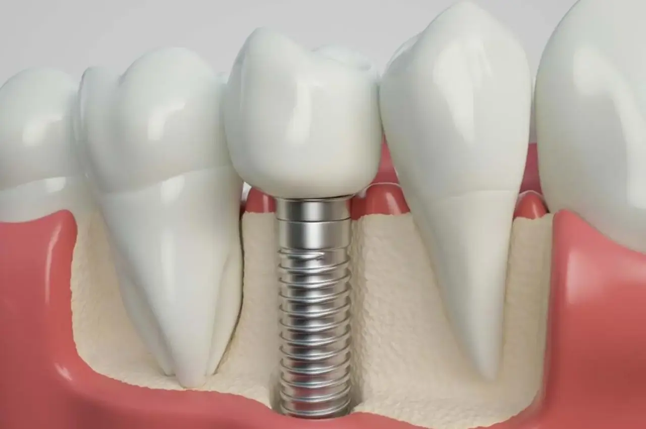 İmplant Vidası Kırılması Implant Vidasi Kirilmasi