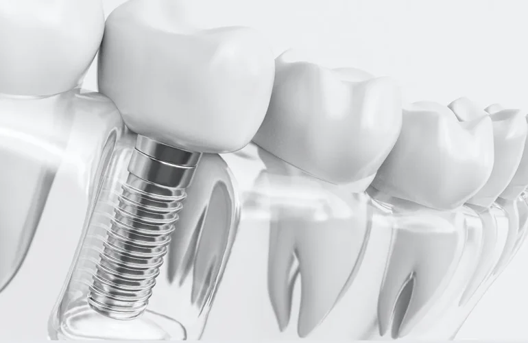 Periimplantitis Nedir? Neden Olur? Belirtileri Nelerdir? Periimplantitis Nedir